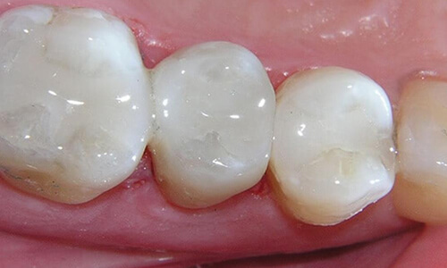 Illustration of a dental fillings procedure done by the Costa Rica Dental Center in San Jose, Costa Rica.  The picture shows a dental filling placed in the lower jaw.